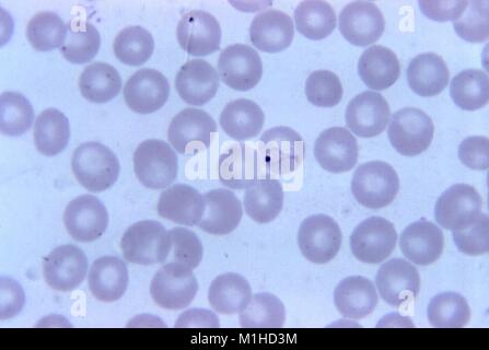 Photomicrographie du parasite du paludisme à Plasmodium vivax dans 'raquette de tennis' forme de formulaire, sur les vitraux de Giemsa, film mince amplifié 1125 x 1973. Image courtoisie CDC/Dr. Mae Melvin. () Banque D'Images