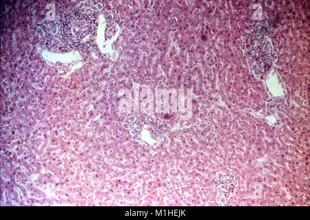 Photomicrographie d'un triaditis avec section hépatique (foie triades l'inflammation), présence d'éosinophiles et des éléments de l'arbre biliaire cholangite (inflammation), les changements qui se produisent des tissus histopathologique en raison de syndrome de choc toxique (SCT), 1984. Image courtoisie CDC/Allen. L. de Paris. () Banque D'Images