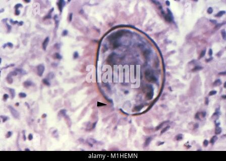 Oeufs de Schistosoma japonicum rachis vestigiales révélé dans le film de micrographie, tirée d'une biopsie des tissus du foie, 1986. Image courtoisie Centres for Disease Control (CDC). () Banque D'Images