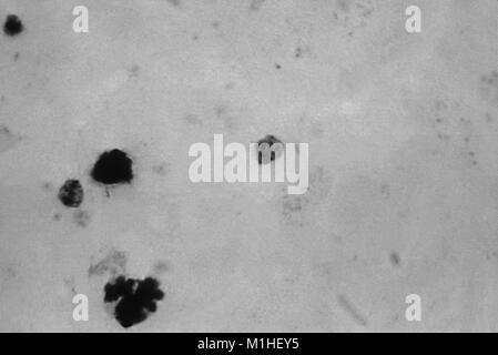 Photomicrographie du parasite du paludisme Plasmodium malariae trophozoïte en phase avec la pigmentation de premier plan, sur un frottis de sang épais, 1965. Image courtoisie CDC/Dr. Mae Melvin. () Banque D'Images