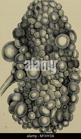 Un traité pratique sur les maladies rénales et urinaires - y compris les dépôts urinaires (1879) (14758241856) Banque D'Images