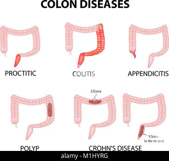 Maladies du côlon. La rectite, colite, appendicite, polype, ulcère, de la maladie de Crohn Vector illustration infographies sur fond isolé Illustration de Vecteur