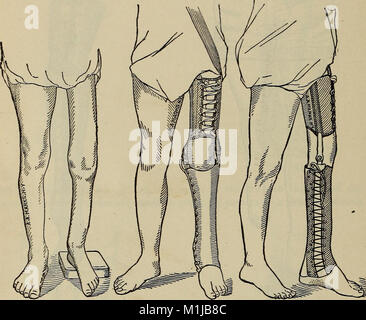 Un traité sur les membres artificiels avec les mains et les pieds en caoutchouc (1901) (14767582545) Banque D'Images