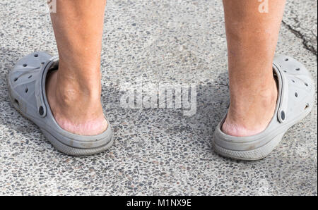 Sandales Crocs. Personne portant Crocs sans chaussettes. La peau craquelée sur le talon Banque D'Images