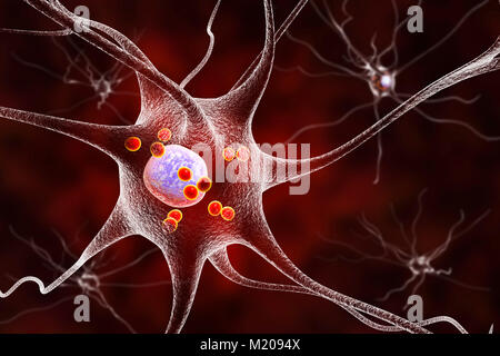 La maladie de Parkinson les cellules nerveuses. Illustration d'ordinateur des droits de cellules nerveuses touchées par Lewy (petites sphères rouges dans le cytoplasme des neurones) dans le cerveau d'un patient avec la maladie de Parkinson. Les corps de Lewy sont des accumulations anormales de protéines qui se développent à l'intérieur des cellules nerveuses dans la maladie de Parkinson, la démence à corps de Lewy, et d'autres troubles neurologiques. Banque D'Images