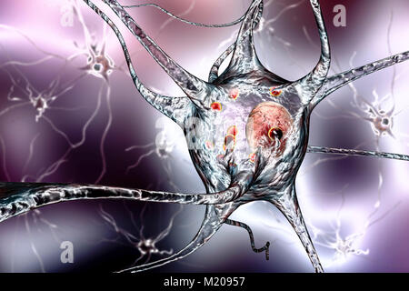 La maladie de Parkinson les cellules nerveuses. Illustration d'ordinateur des droits de cellules nerveuses touchées par Lewy (petites sphères rouges dans le cytoplasme des neurones) dans le cerveau d'un patient avec la maladie de Parkinson. Les corps de Lewy sont des accumulations anormales de protéines qui se développent à l'intérieur des cellules nerveuses dans la maladie de Parkinson, la démence à corps de Lewy, et d'autres troubles neurologiques. Banque D'Images