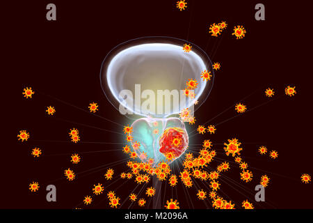 Étiologie virale du cancer de la prostate. Conceptual illustration virus infectant la prostate et provoquer le cancer du développement. Banque D'Images