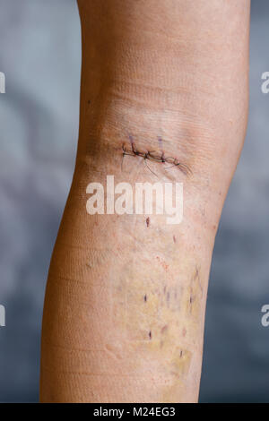 La jambe de womans après phlébectomie, avec sutures chirurgicales visibles (points de suture) et les blessures sur sa jambe. Le traitement curatif, procédures esthétiques, thrombose préc Banque D'Images