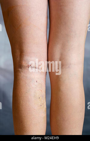 Les jambes de womans après chirurgie des varices visibles, avec des sutures chirurgicales (suture) et les blessures sur une jambe. Le traitement curatif, procédures esthétiques, thr Banque D'Images