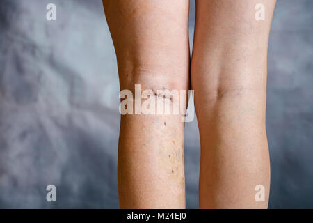 Les jambes de womans après phlébectomie, avec sutures chirurgicales visibles (points de suture) et les blessures sur une jambe. Le traitement curatif, procédures esthétiques, thrombose pre Banque D'Images