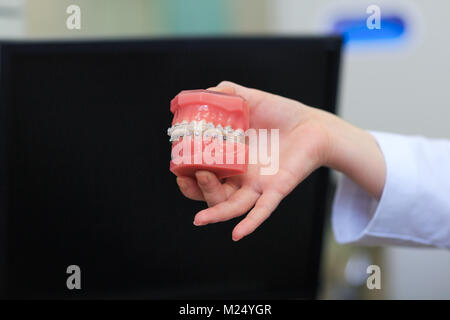 Dent dentiste holding model with metal connexion appareil dentaire. Soins dentaires Orthodontie dents modèle avec appareil dentaire implants ou mâchoire humaine. Image de dentier Banque D'Images