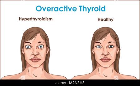Visage d'une femme adulte présentant des symptômes d'hyperthyroïdie. Illustration de Vecteur