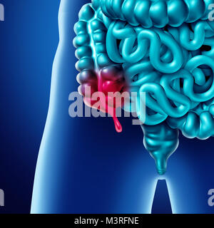 La douleur et l'inflammation l'appendice Appendicite Maladie concept comme un gros plan d'intestin humain comme une anatomie 3D illustration. Banque D'Images