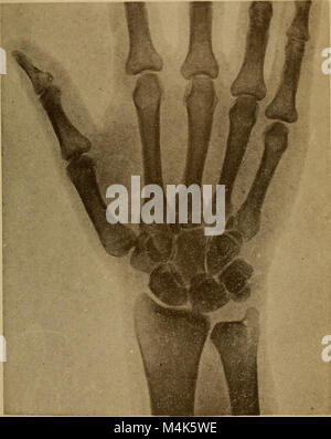 Atlas et exemple même de fractures et luxations traumatiques (1902) (14777209791) Banque D'Images
