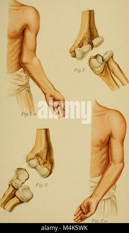 Atlas et exemple même de fractures et luxations traumatiques (1902) (14779880832) Banque D'Images