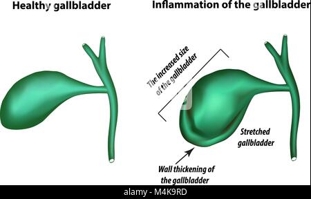 Les symptômes de l'inflammation de la vésicule biliaire. De la cholécystite. Un épaississement de la paroi de la vésicule biliaire. L'augmentation de la vésicule biliaire. L'infographie. Vector illustration Illustration de Vecteur