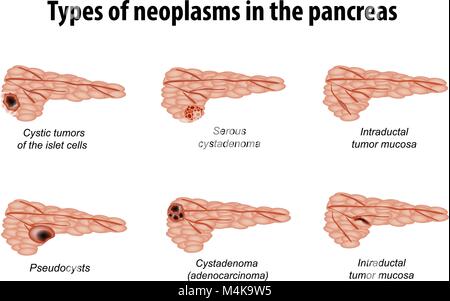 Types de tumeurs du pancréas. L'infographie. Set. Vector illustration sur fond isolé. Illustration de Vecteur