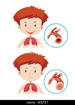 Les garçons avec des poumons sains et malsains illustration Illustration de Vecteur