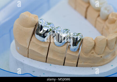 Une prothèse selle avec dentition artificielle dans un laboratoire dentaire Banque D'Images