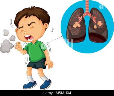 Garçon et cigarette poumons malsains illustration diagramme Illustration de Vecteur