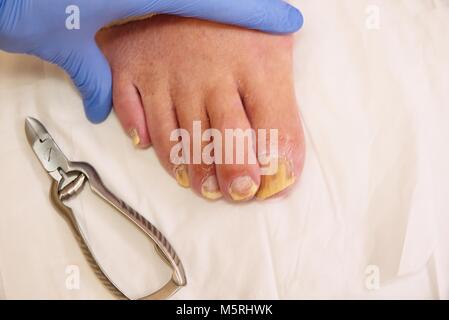 Champignon sur les ongles des orteils. Twisted orteils sur le pied avec des durillons. Hallux rigidus tend à affecter les hommes pied. Banque D'Images