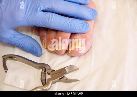 Champignon sur les ongles des orteils. Twisted orteils sur le pied avec des durillons. Hallux rigidus tend à affecter les hommes pied. Banque D'Images