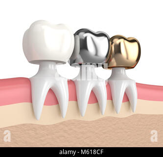 3D render de dents avec de l'or, l'amalgame et la couronne dentaire composite dans les gencives Banque D'Images