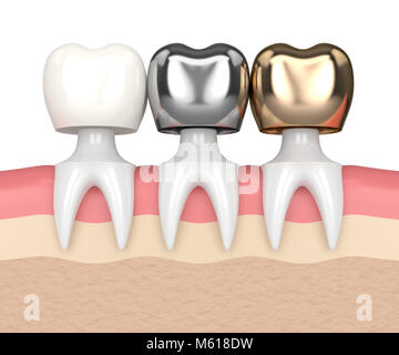 3D render de dents avec de l'or, l'amalgame et la couronne dentaire composite dans les gencives Banque D'Images