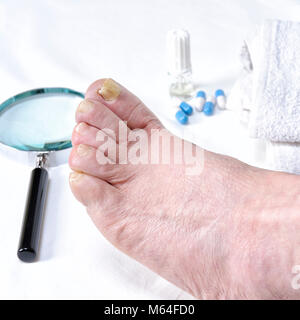 Close up of nail touchée par l'onychomycose à la suite de l'action de champignons pathogènes. Banque D'Images