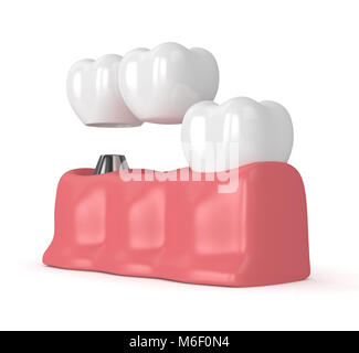 3D render of implant dentaire avec pont cantilever et dent saine dans les gencives isolated over white background Banque D'Images