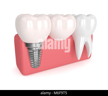 3D render of implant dentaire avec pont cantilever et dent saine dans les gencives isolated over white background Banque D'Images