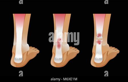 Schéma de l'os cassé dans le pied de l'illustration Illustration de Vecteur