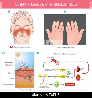 L'inflammation de la peau des patients à partir de la lumière. L'illustration. En raison de la perte de la tolérance à l'autonomie conduit à des dommages du système immunitaire à médiation auto La b Illustration de Vecteur