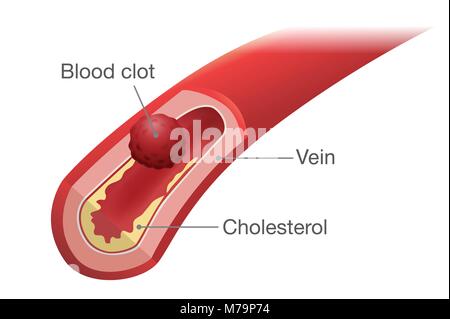 Caillot sanguin se produit dans une veine. Illustration de Vecteur
