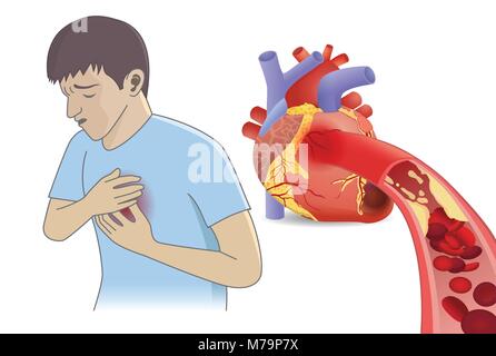 L'homme ont des douleurs à la poitrine à partir de cellules de sang ne peut pas couler dans coeur en gras. Illustration de Vecteur