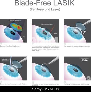 La méthode utilisée par les lasers LASIK sans lame pour créer des volets de la cornée est revendiquée pour améliorer la sécurité de la chirurgie LASIK. Illustration de Vecteur