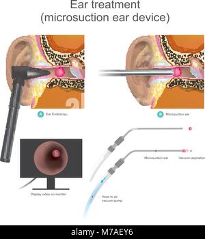 L'aspiration périphérique Micro oreille il est vide système de travail. Les médecins utilisent la pompe à vide d'air à l'aspiration de forme sphérique à l'intérieur de l'oreille. L'illustration. Illustration de Vecteur