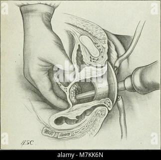 Un manuel de gynaecology et chirurgie pelvienne, pour les étudiants et les praticiens (1916) (14580985110) Banque D'Images