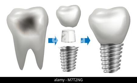 Vecteur d'Implant dentaire. Dent avec la carie. Implant dentaire la santé. Clinique dentaire Stomatologie Flyer. Illustration isolé réaliste Illustration de Vecteur