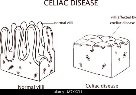 La maladie cœliaque ou de la maladie cœliaque. grêle montrant la maladie cœliaque se traduit par émousser de villosités. Illustration de Vecteur