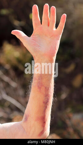 Ecchymose (hématome) causé par une hémorragie interne à la suite d'un test de sang ayant été effectuée. Banque D'Images