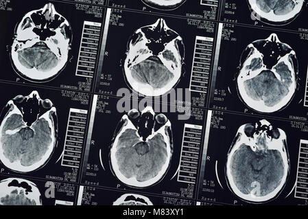 CT Scan d'un mâle humain Cerveau, Close Up Banque D'Images