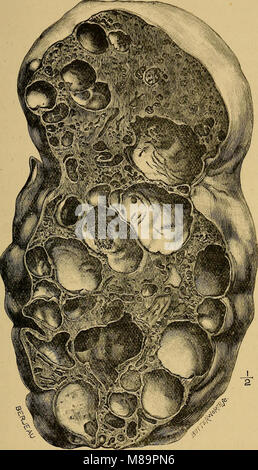 Calculs biliaires et les maladies de la bile-conduits (1908) (14590985677) Banque D'Images