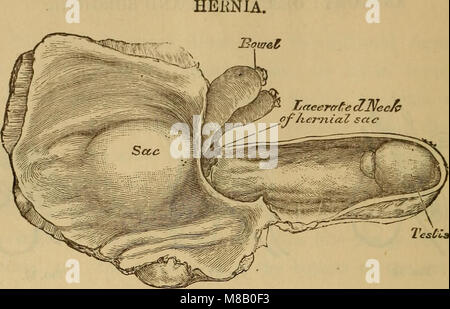 Hernie étranglée, et réductible. Avec le traitement par injections sous-cutanée, avec sugcested ( !) et l'amélioration des méthodes pour kelotomy. Aussi une annexe donnant un bref compte-rendu de divers nouvelle intervention chirurgicale (14580354210) Banque D'Images