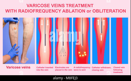 Varices et le traitement par ablation par radiofréquence Banque D'Images