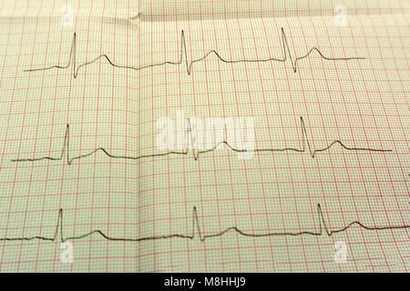 Extrasystole sur l'enregistrement de l'électrocardiogramme 12 dérivations Paper Banque D'Images