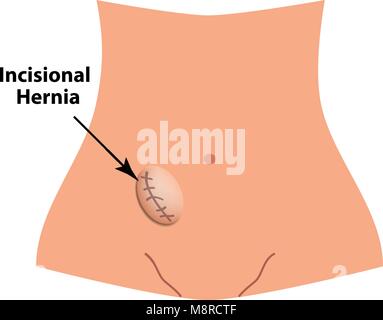 Hernie incisionnelle. hernie intestinale. L'infographie. Vector illustration sur fond isolé. Illustration de Vecteur