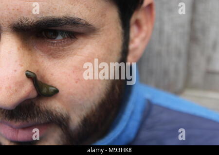 Srinagar, Inde. Mar 21, 2018. Une thérapie locale cachemiriens reçoit les sangsues dans Srinagar Hazratbal la capitale d'été du Cachemire indien. L'utilisation de sangsues du cachemire pour traiter les personnes souffrant de démangeaisons et de la douleur. Les sangsues sont souvent utilisés pour guérir les maux, de la circulation du sang à la peau en médecine traditionnelle au Cachemire Nowruz qui marque le premier jour du printemps et le début de l'année dans le calendrier Persan Crédit : Arfath Naseer/ Pacific Press/Alamy Live News Banque D'Images