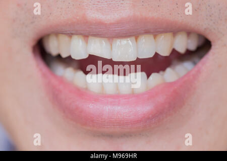 Les blessures ou les dents Dents de rupture dans le mâle. Les traumatismes et d'un nerf de la dent, les dents permanentes de blessés graves. Banque D'Images