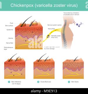Transmise par inhalation du virus de la varicelle dans les aérosols. Les infections de peau et de la fièvre. Une maladie douloureuse causée par des lésions nerveuses. Illustratio Illustration de Vecteur